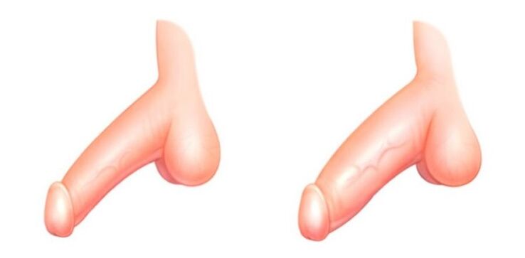 penis pred in po povečanju